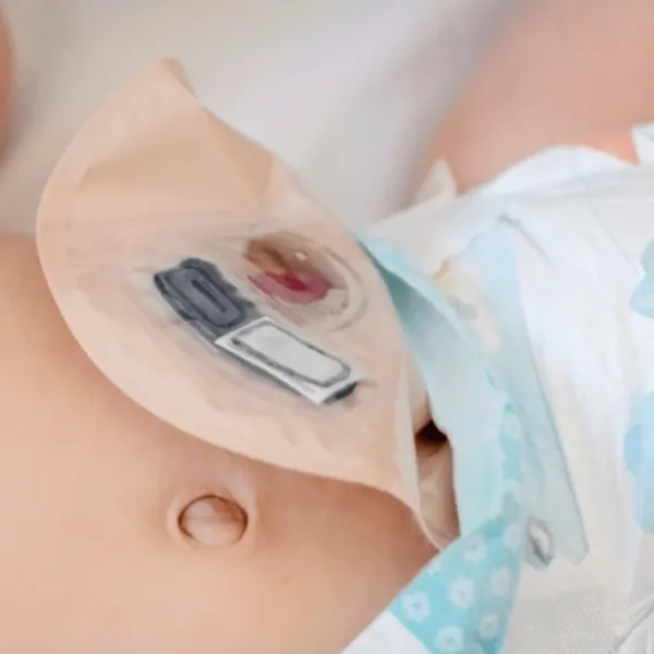 Phẫu thuật đại tràng ở trẻ em: Những điều cần lưu ý tại nhà