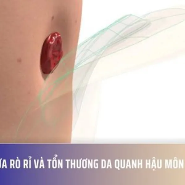 Ngăn Ngừa Rò Rỉ và Tổn Thương Da Quanh Hậu Môn Nhân Tạo