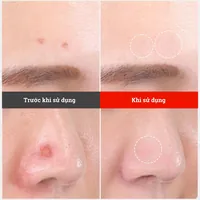 Miếng dán mụn Somaderm Spot hỗ trợ nhanh lành vết thương (18 miếng)