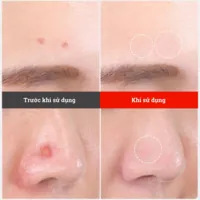 Miếng dán mụn Somaderm-Thin giảm hình thành sẹo loại mỏng (24 miếng)