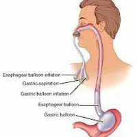 Ống chẹn thực quản, dạ dày SENGSTAKEN BLACKEMORE TUBE